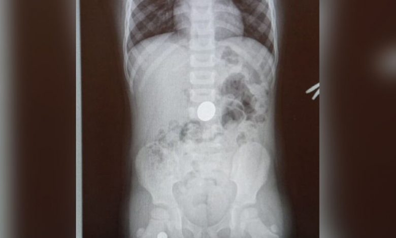 Фото - В Туапсе врачи извлекли из желудка четырехлетнего ребенка пятирублевую монету